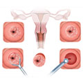 Eletrocauterização de lesões de vulva, vagina e colo uterino;